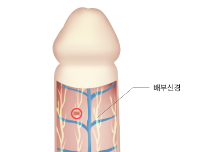 배부신경차단술